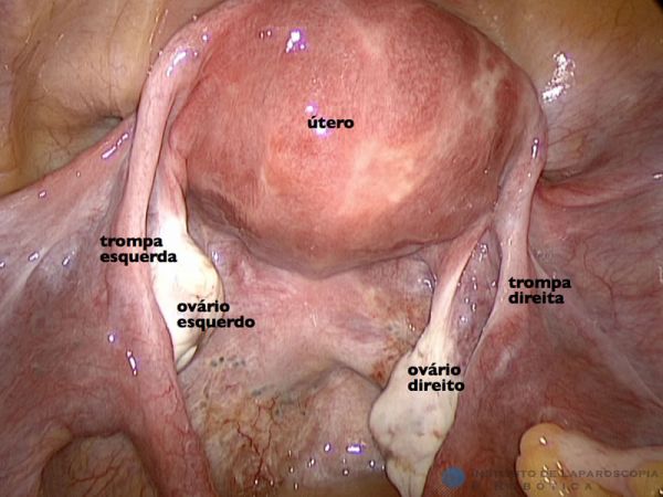 Videolaparoscopia em Ginecologia